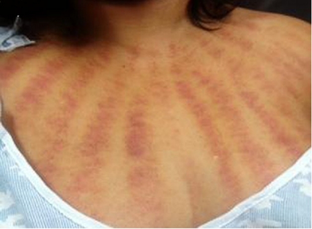 New Onset of Linear Purpura on the Back: Coining Therapy-Associated Ecchymoses - PMC